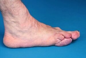 Síndrome de Proteus se origina de uma mutação genética